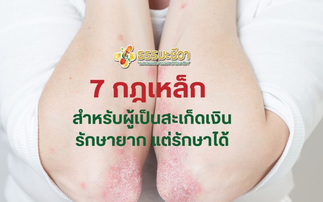 7 กฎเหล็ก สำหรับผู้เป็นสะเก็ดเงิน รักษายาก แต่รักษาได้