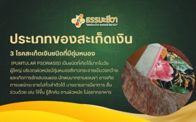 3 โรคสะเก็ดเงินชนิดที่มีตุ่มหนอง