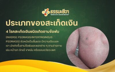 4 โรคสะเก็ดเงินชนิดเกิดตามข้อพับ